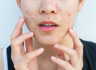 Acne Woman Fingers Gettyimages 1175841515