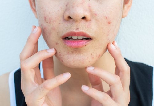 Acne Woman Fingers Gettyimages 1175841515